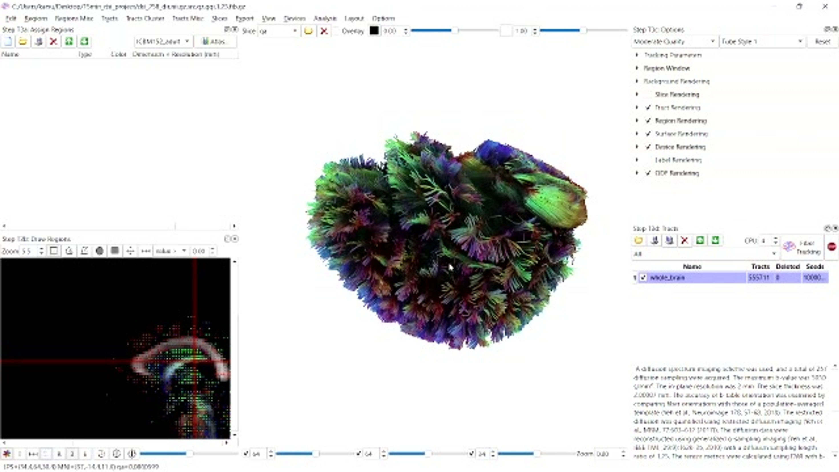 DTI of a normal human without any disorders in relaxing condition